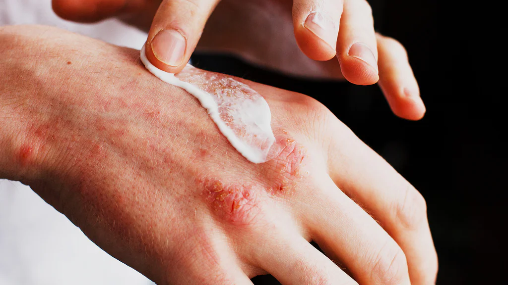 6-MONTH ECZEMA PROGRAMME