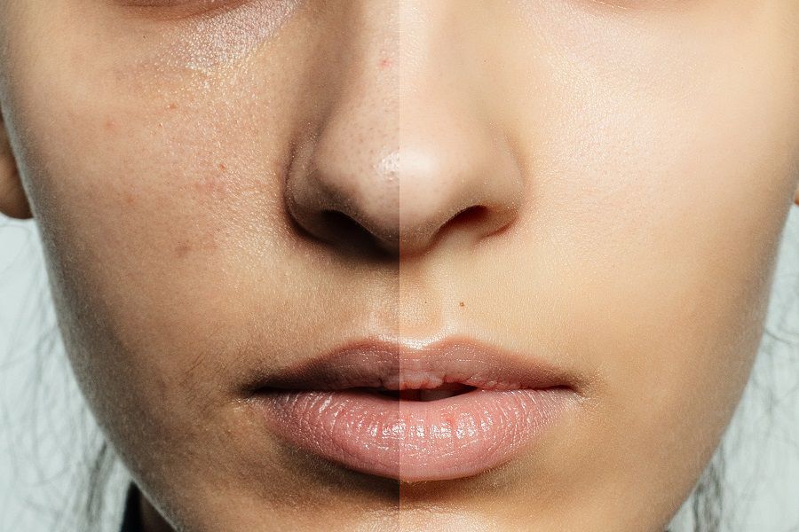 6-MONTH PIGMENTATION PROGRAMME